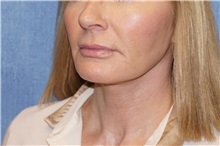 Facelift After Photo by George John Alexander, MD, FACS; ,  - Case 37841