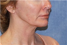 Facelift Before Photo by George John Alexander, MD, FACS; ,  - Case 37841