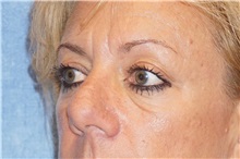 Eyelid Surgery Before Photo by George John Alexander, MD, FACS; Las Vegas, NV - Case 37844