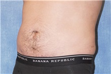 Liposuction After Photo by George John Alexander, MD, FACS; ,  - Case 38181