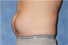 Liposuction Before Photo by George John Alexander, MD, FACS; ,  - Case 38181