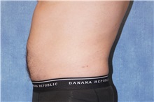 Liposuction After Photo by George John Alexander, MD, FACS; ,  - Case 38181