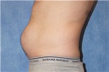 Liposuction Before Photo by George John Alexander, MD, FACS; ,  - Case 38181