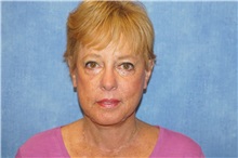 Facelift After Photo by George John Alexander, MD, FACS; ,  - Case 38186