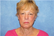 Facelift Before Photo by George John Alexander, MD, FACS; ,  - Case 38186