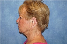 Facelift Before Photo by George John Alexander, MD, FACS; ,  - Case 38186