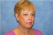 Facelift After Photo by George John Alexander, MD, FACS; ,  - Case 38186
