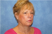 Facelift Before Photo by George John Alexander, MD, FACS; ,  - Case 38186
