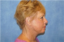 Facelift After Photo by George John Alexander, MD, FACS; ,  - Case 38186