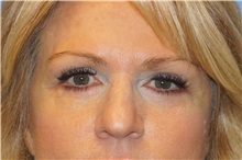 Eyelid Surgery After Photo by George John Alexander, MD, FACS; Las Vegas, NV - Case 38187
