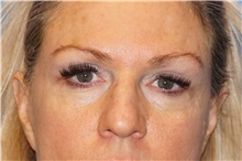 Eyelid Surgery Before Photo by George John Alexander, MD, FACS; Las Vegas, NV - Case 38187