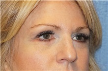 Eyelid Surgery After Photo by George John Alexander, MD, FACS; Las Vegas, NV - Case 38187