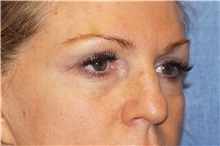 Eyelid Surgery Before Photo by George John Alexander, MD, FACS; Las Vegas, NV - Case 38187