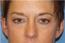 Eyelid Surgery Before Photo by George John Alexander, MD, FACS; ,  - Case 38188