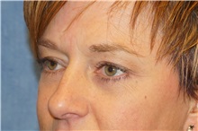 Eyelid Surgery After Photo by George John Alexander, MD, FACS; ,  - Case 38188