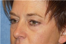Eyelid Surgery Before Photo by George John Alexander, MD, FACS; ,  - Case 38188
