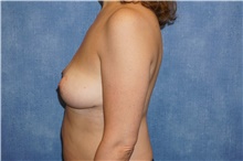 Breast Implant Removal After Photo by George John Alexander, MD, FACS; ,  - Case 38675