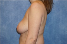 Breast Implant Removal Before Photo by George John Alexander, MD, FACS; ,  - Case 38675