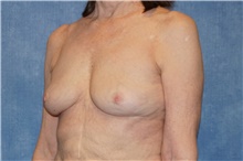 Breast Implant Removal After Photo by George John Alexander, MD, FACS; ,  - Case 38676