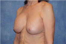 Breast Implant Removal Before Photo by George John Alexander, MD, FACS; ,  - Case 38676