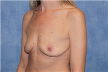Breast Implant Removal After Photo by George John Alexander, MD, FACS; ,  - Case 38677