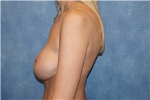 Breast Implant Removal Before Photo by George John Alexander, MD, FACS; ,  - Case 38677