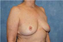 Breast Implant Removal After Photo by George John Alexander, MD, FACS; ,  - Case 38678