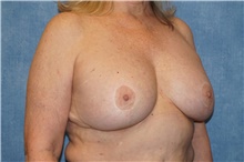 Breast Implant Removal Before Photo by George John Alexander, MD, FACS; ,  - Case 38678