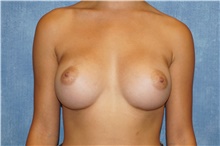 Breast Augmentation After Photo by George John Alexander, MD, FACS; ,  - Case 39674