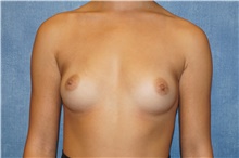 Breast Augmentation Before Photo by George John Alexander, MD, FACS; ,  - Case 39674