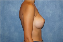 Breast Augmentation After Photo by George John Alexander, MD, FACS; ,  - Case 39674