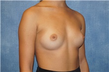 Breast Augmentation Before Photo by George John Alexander, MD, FACS; ,  - Case 39674