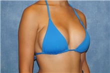Breast Augmentation After Photo by George John Alexander, MD, FACS; ,  - Case 39674