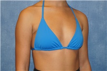 Breast Augmentation Before Photo by George John Alexander, MD, FACS; ,  - Case 39674