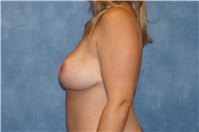 Breast Reduction After Photo by George John Alexander, MD, FACS; ,  - Case 44027