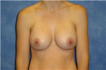 Breast Implant Revision After Photo by George John Alexander, MD, FACS; Las Vegas, NV - Case 44042