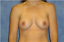 Breast Implant Revision Before Photo by George John Alexander, MD, FACS; Las Vegas, NV - Case 44042