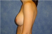 Breast Implant Revision After Photo by George John Alexander, MD, FACS; Las Vegas, NV - Case 44042