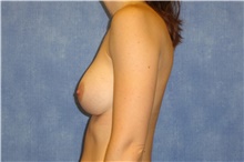 Breast Implant Revision Before Photo by George John Alexander, MD, FACS; Las Vegas, NV - Case 44042
