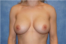 Breast Implant Revision After Photo by George John Alexander, MD, FACS; Las Vegas, NV - Case 44069