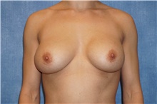 Breast Implant Revision Before Photo by George John Alexander, MD, FACS; Las Vegas, NV - Case 44069