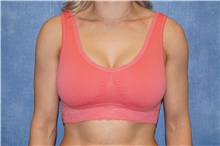 Breast Implant Revision After Photo by George John Alexander, MD, FACS; Las Vegas, NV - Case 44069