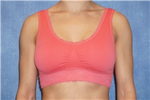 Breast Implant Revision Before Photo by George John Alexander, MD, FACS; Las Vegas, NV - Case 44069