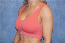 Breast Implant Revision After Photo by George John Alexander, MD, FACS; Las Vegas, NV - Case 44069