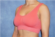 Breast Implant Revision Before Photo by George John Alexander, MD, FACS; Las Vegas, NV - Case 44069