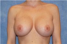 Breast Implant Revision After Photo by George John Alexander, MD, FACS; Las Vegas, NV - Case 44105
