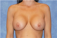 Breast Implant Revision Before Photo by George John Alexander, MD, FACS; Las Vegas, NV - Case 44105