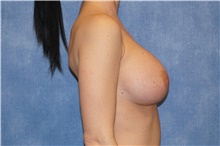Breast Implant Revision After Photo by George John Alexander, MD, FACS; Las Vegas, NV - Case 44105