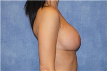 Breast Implant Revision Before Photo by George John Alexander, MD, FACS; Las Vegas, NV - Case 44105