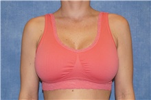 Breast Implant Revision After Photo by George John Alexander, MD, FACS; Las Vegas, NV - Case 44105
